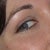 BEFORE Juvederm overfill and hyaluronidase. Pic from 2009. Residual restylane still in lower lid. Full smile but no lines, wrinkles or folds. No purple tear trough. Skin is a good healthy color.