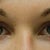 BEFORE Juvederm in January 2010. Note no natural bags or excess skin. NO PURPLE TEAR TROUGH.