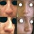 Left: Before surgery, Right: 2 months and four days after surgery. I am completely happy with the results!