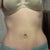Front.  5 weeks post op