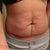 Before pic front