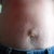 mini tummy tuck