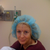 Pre-op, eyes marked with marker to show where laser resurfacing should be done