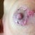 Day 23 - First indication of body rejecting dissolvable suture.