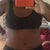 1 Week PO, with clothes-- i am in LOVE with the skill of Dr. Linderman and the height of the scar-- magnifique!