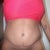 7 months post tt
