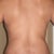 4.5 mos Post-Op