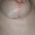 Hypertrophic scar in right breast which never resolved, even after applying medical-grade silicone sheets (Scar Fx)12 hours daily for 6 months two weeks post-op after 1st bilateral mastopexy.