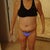 6 days Post op. I am holding my drains. They are normally pinned onto a compression garment. These came out at 8 days PO, for me.