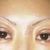 Day 13 post op, still very swollen, scar revision by left eye, under eye skin was lasered to tighten and help sunspots in upper cheek area