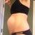 Side view, four days before surgery