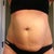 Front view, four days before surgery