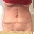 1 month PO. Really swollen. Left side more so(pics left)