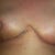 2 weeks post op