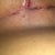 right side underneath 2 weeks post op