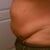 Day before surgery