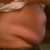 Other side before surgery