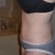 7 weeks post op