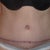 Incision and belly button are slowly getting better
