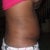 right side 12days post tt