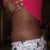 left side 12days post tt