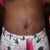 12days post tt, you can see how low my scar is. i also have some marks from the binder and my stretch marks are swollen