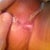 this is under my breast,when i fell,i busted my incision open