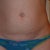 2.5 weeks pre surgery