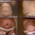 Before and After Shots - Post Op 3 days and swollen