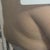 Fat hanging bad from upper back. Grrr 4 weeks 3 days post op.