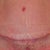3 1/2 weeks post op, tummy incision