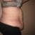 pre-op right side