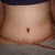 2 days post op