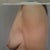 This picture was my before from the Dr's office.