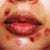 scab flaking