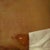 Day 1 Post, I take a peek & surprise!  Mr. Blister grew under my Binder.  I was prepared for skin issues because I have Hyper Atopic Dermatitis & probably more skin issues that I'm not aware of.  I can't wear bandaids, paper tape & all that.