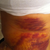 5 Days Post - Part of recovery - You can see the quality work here.