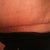 10 Weeks/1 Day Post - The scar is healing well.  I will continue to nourish and massage it.