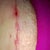 About 3 inches of scar above my moms is getting open areas. I found a stitch sticking out the middle. I am pretty worried!