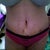13 days post op