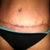 7 weeks 4 days PO
Took pictures this morning, but they look exactly the same as 41 days PO, so decided to post a pic of what my scar looks like now!