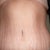 After 2.5 weeks..Love my new belly button.  I have never liked mine.  I was teased relentlessly as a child because I had an outie.  And....I have a waist!! Woo Hoo!  I will always have stretch marks but I don't even care at this point!