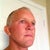 2 weeks after surgery...  scars around my ears are healing pretty good.  Still pretty swollen under my chin, side of face and under eyes (pulling my lower eyelids down a little still).  So far, so good...