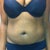 Day of surgery (pre) front pic....I lost 10 lbs