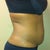 Day of surgery (pre) side pic....I lost 10 lbs