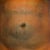 Day 2 post procedure (front).....still draining & swollen; but much improved compared to pre-op.