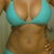 34DD Breast Silicone Gel Implant By Dr Kim
my mensuration are now 5'7 / 162 lbs / 41-29-42