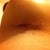 Left incision post op day 1