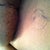 The circle is where the Q pump was. This little thing injected medicine fore 5 days :-) pretty cool