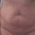PRE OP